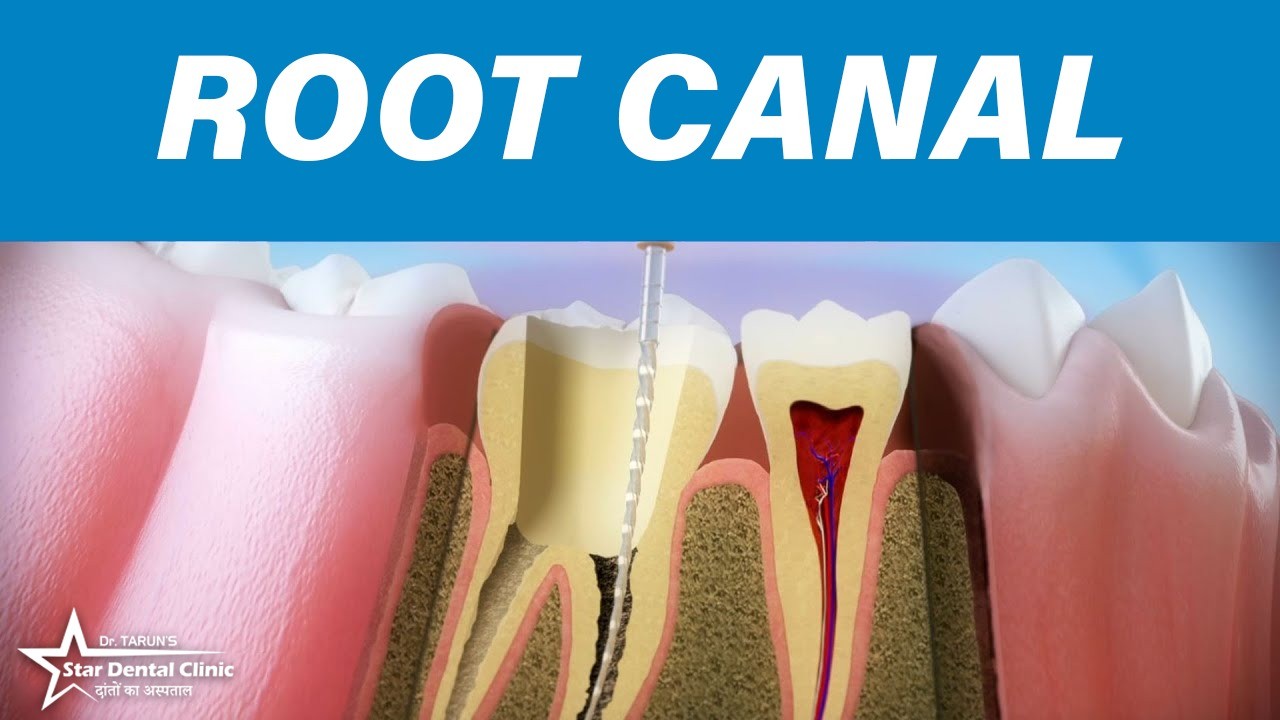 The Complete Guide to Root Canal in Dentistry